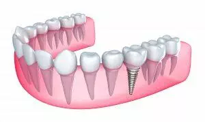 Bradford Dental Implants How it works