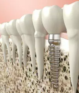 Dental Implant 3D -  - Prosper with Dental Implants