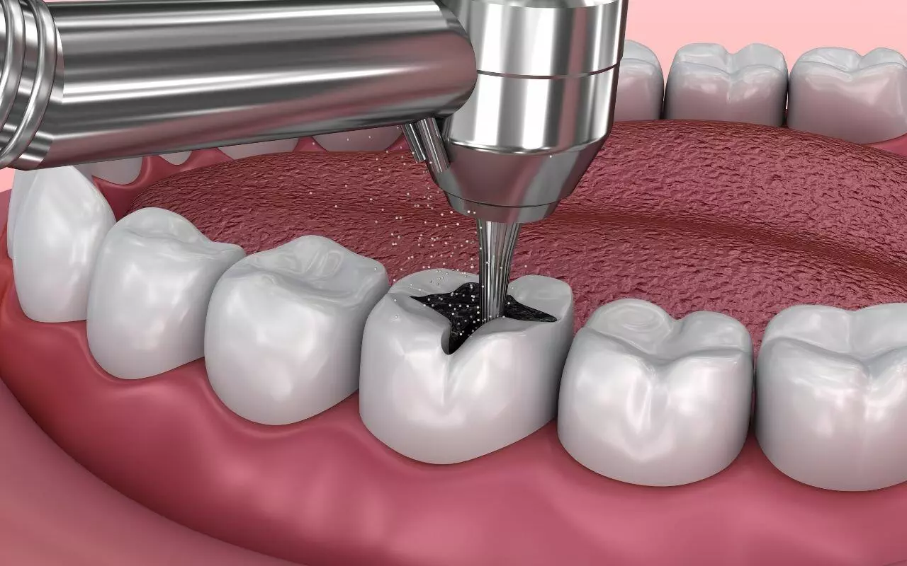 tooth-decay-is-removed-with-drill-Bradford-Dentist