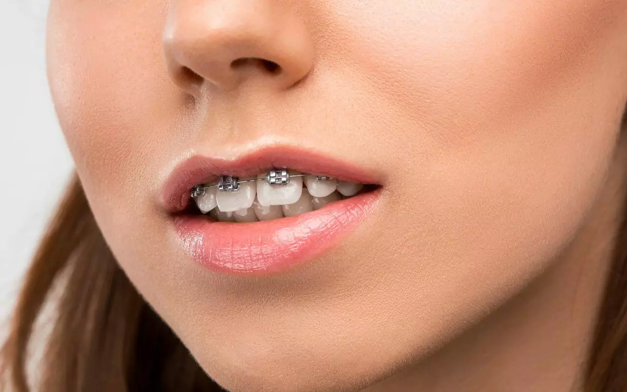 Braces Before And After - Bradford Family Dentistry