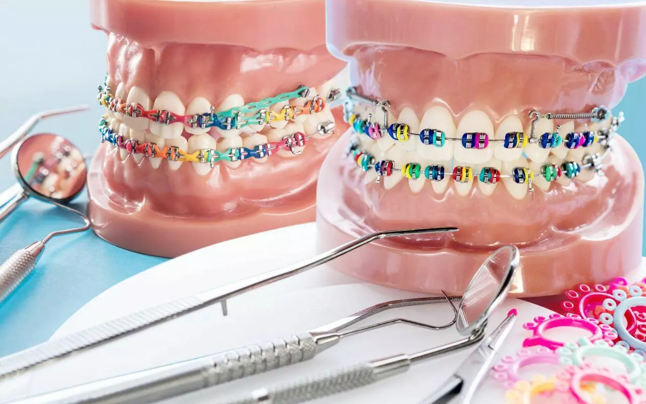 moms-guide-to-making-braces-fun-embrace-latest-orthodontic-trends