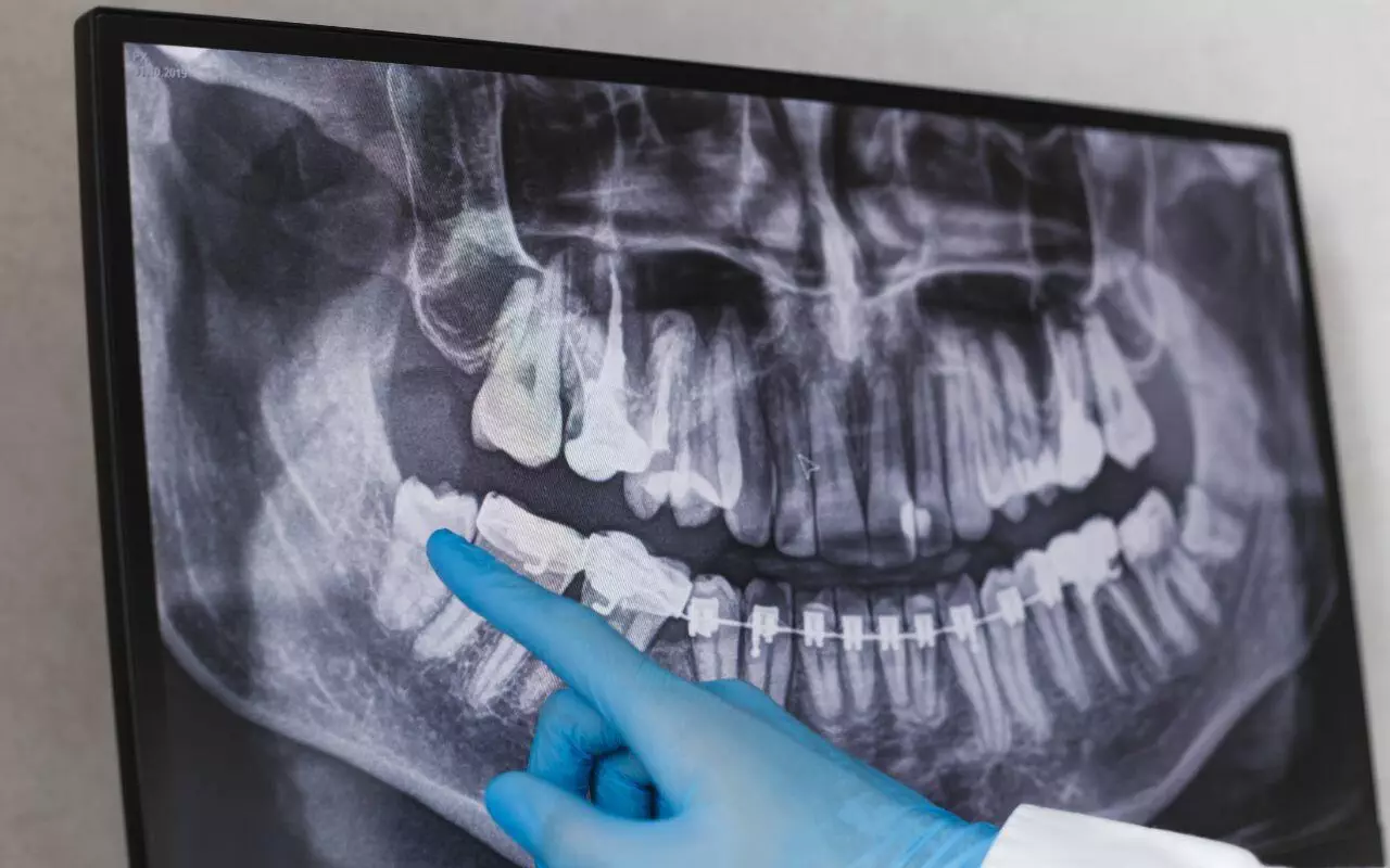 A dentist is pointing at an x - ray of a patients wisdom teeth.