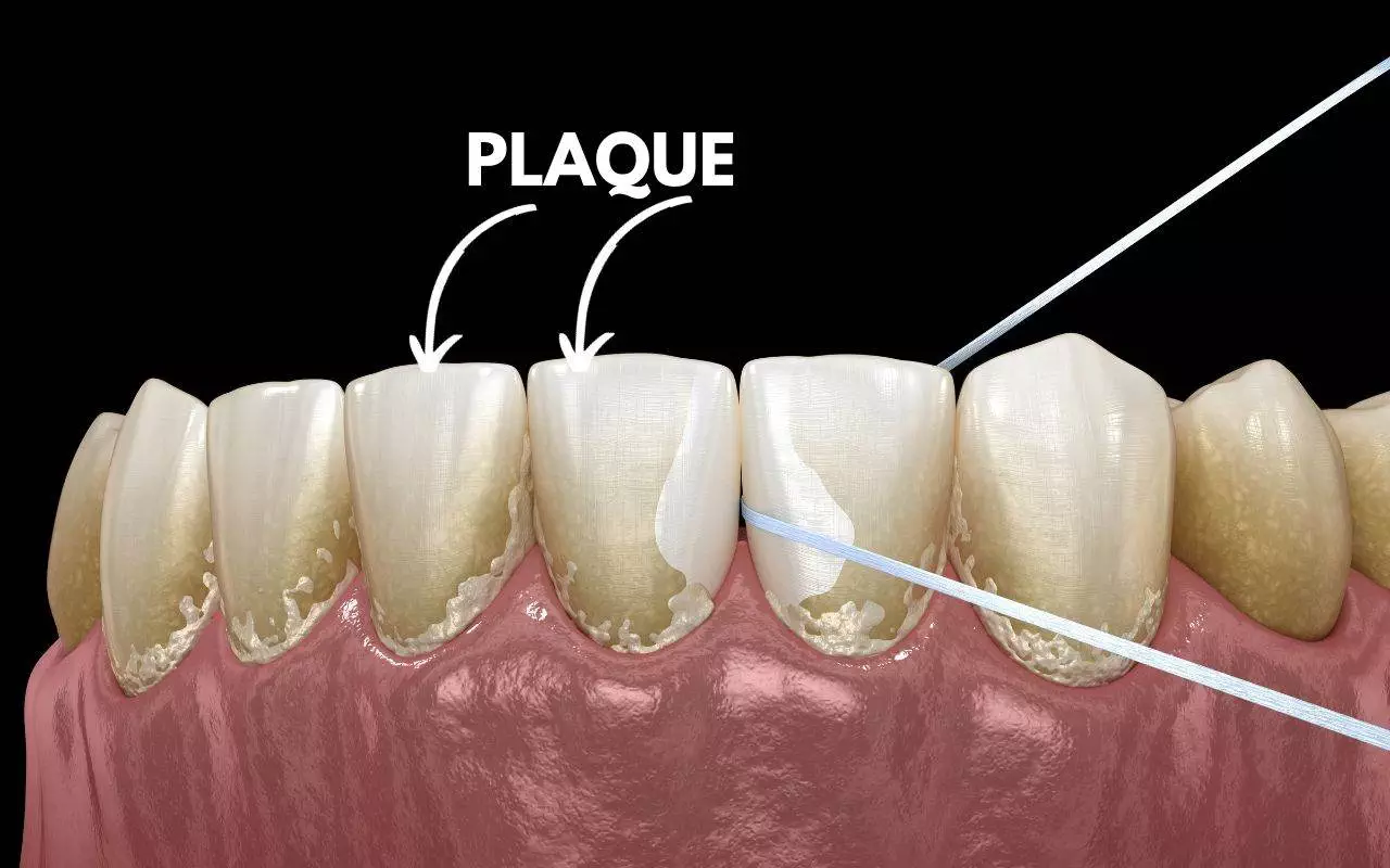A diagram of plaque on a tooth.