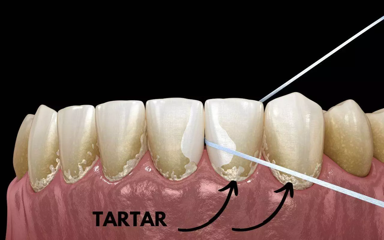 An illustration of a tooth with tartar on it.