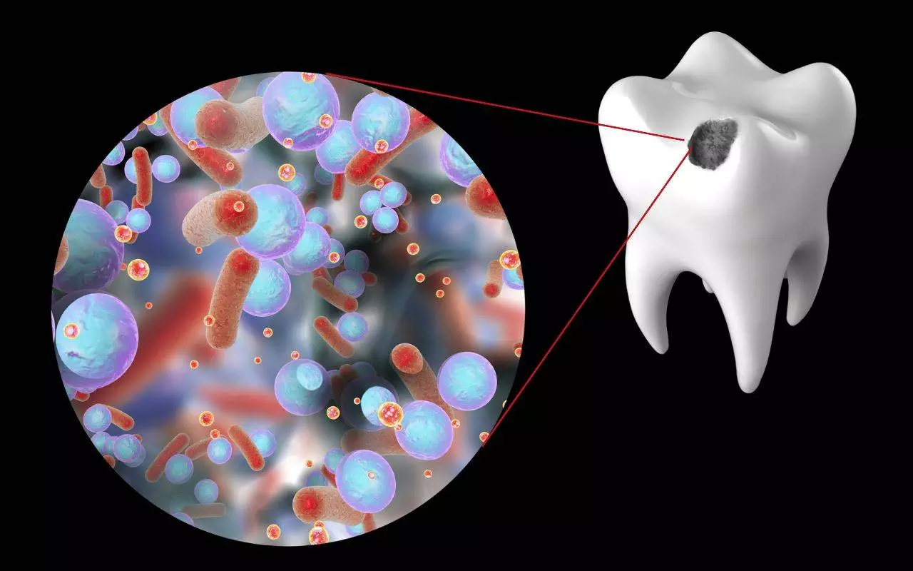 Why cavities are a problem - An image of a tooth with a cavity and bacteria inside