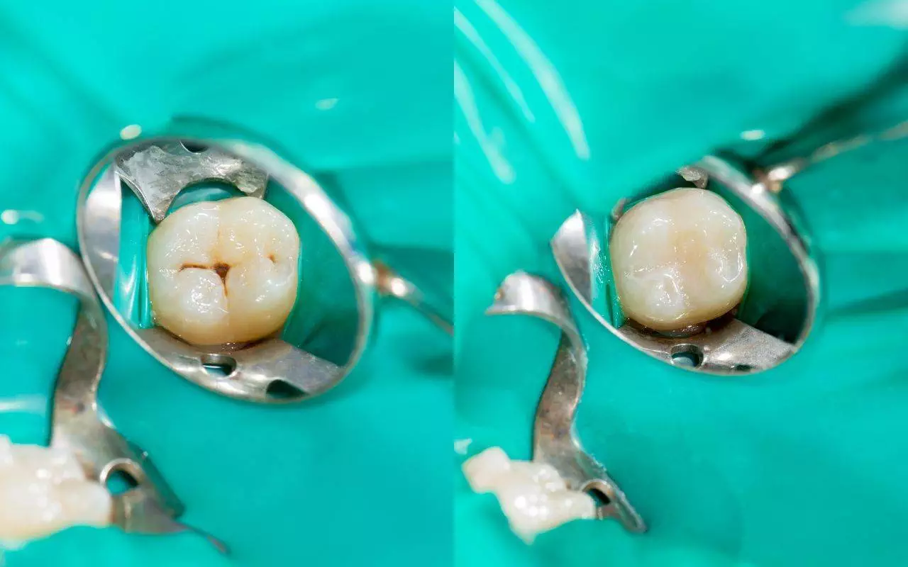 Before and after photos of a dental filling.