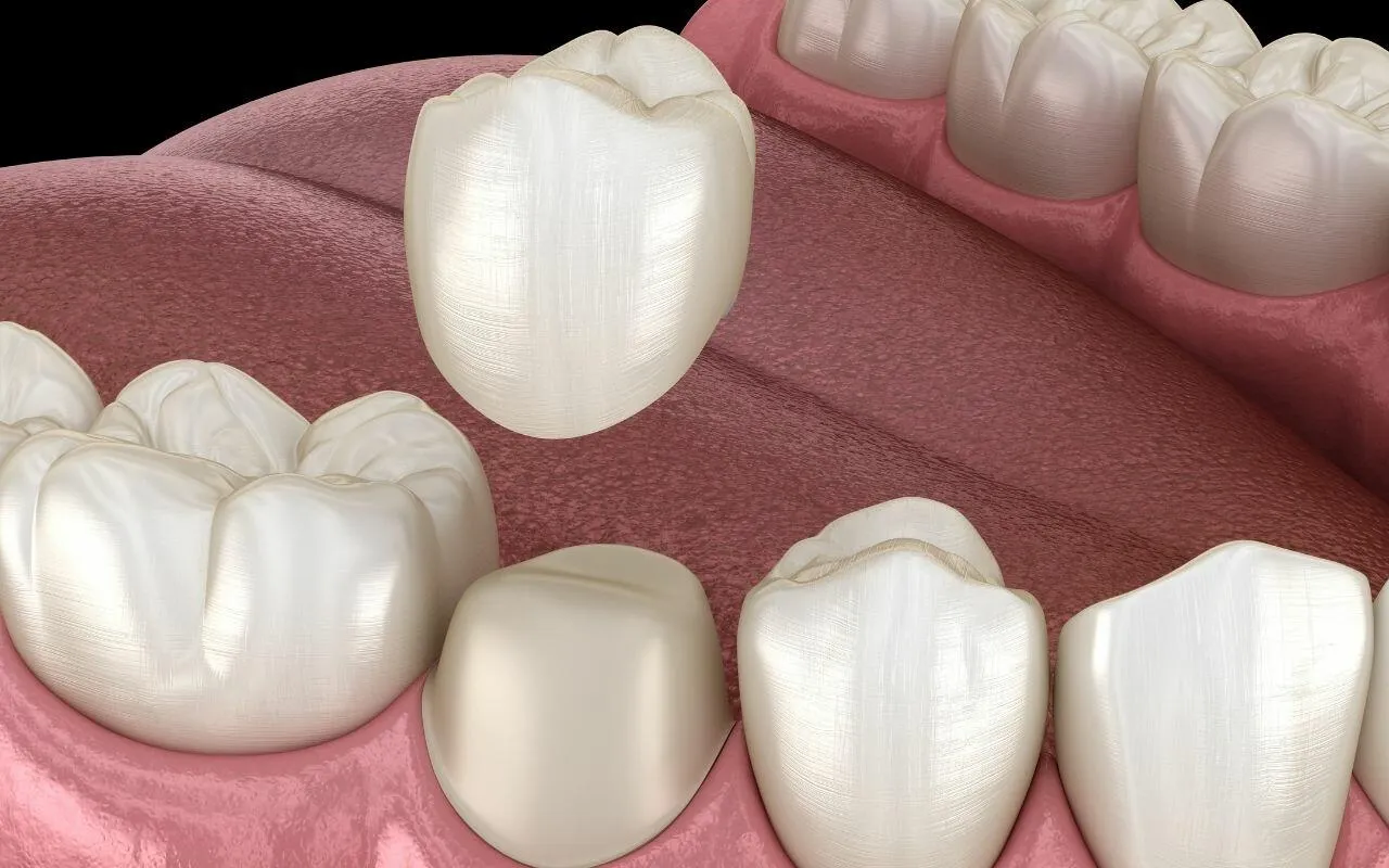 difference between crown and implants Bradford Dentist Bradford