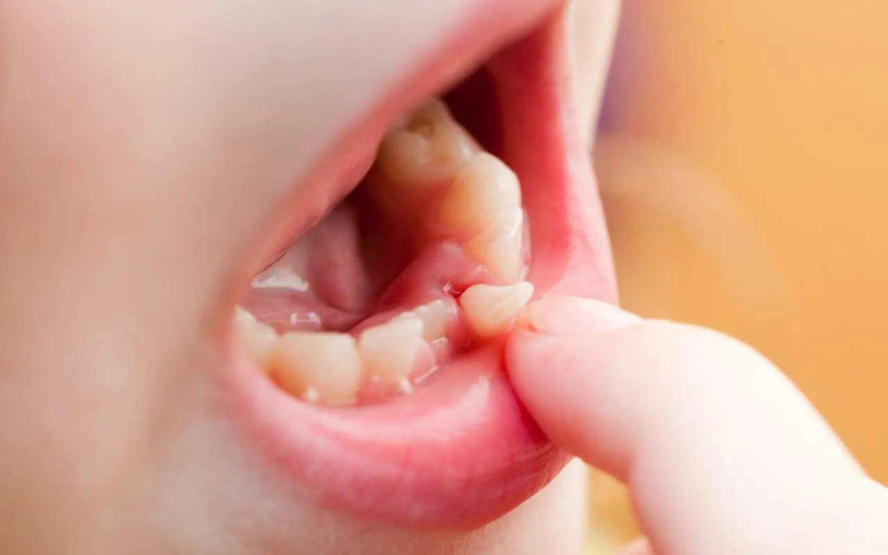 Over Retained Primary Teeth
