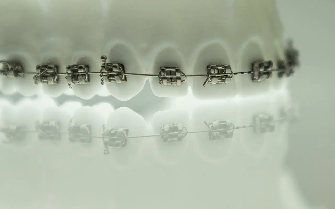 what are braces - dental problems that can be corrected with braces