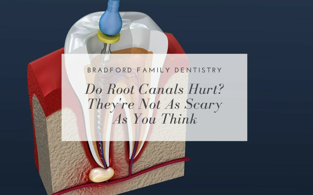 Do Root Canals Hurt? They're Not As Scary As You Think Bradford
