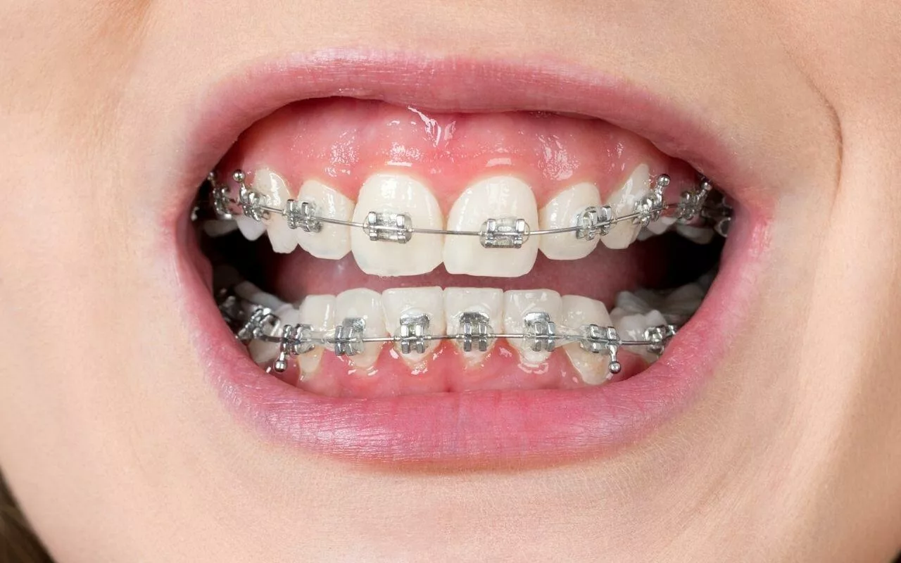 The Definitive Guide To Cleaning Teeth With Braces - Bradford Family ...