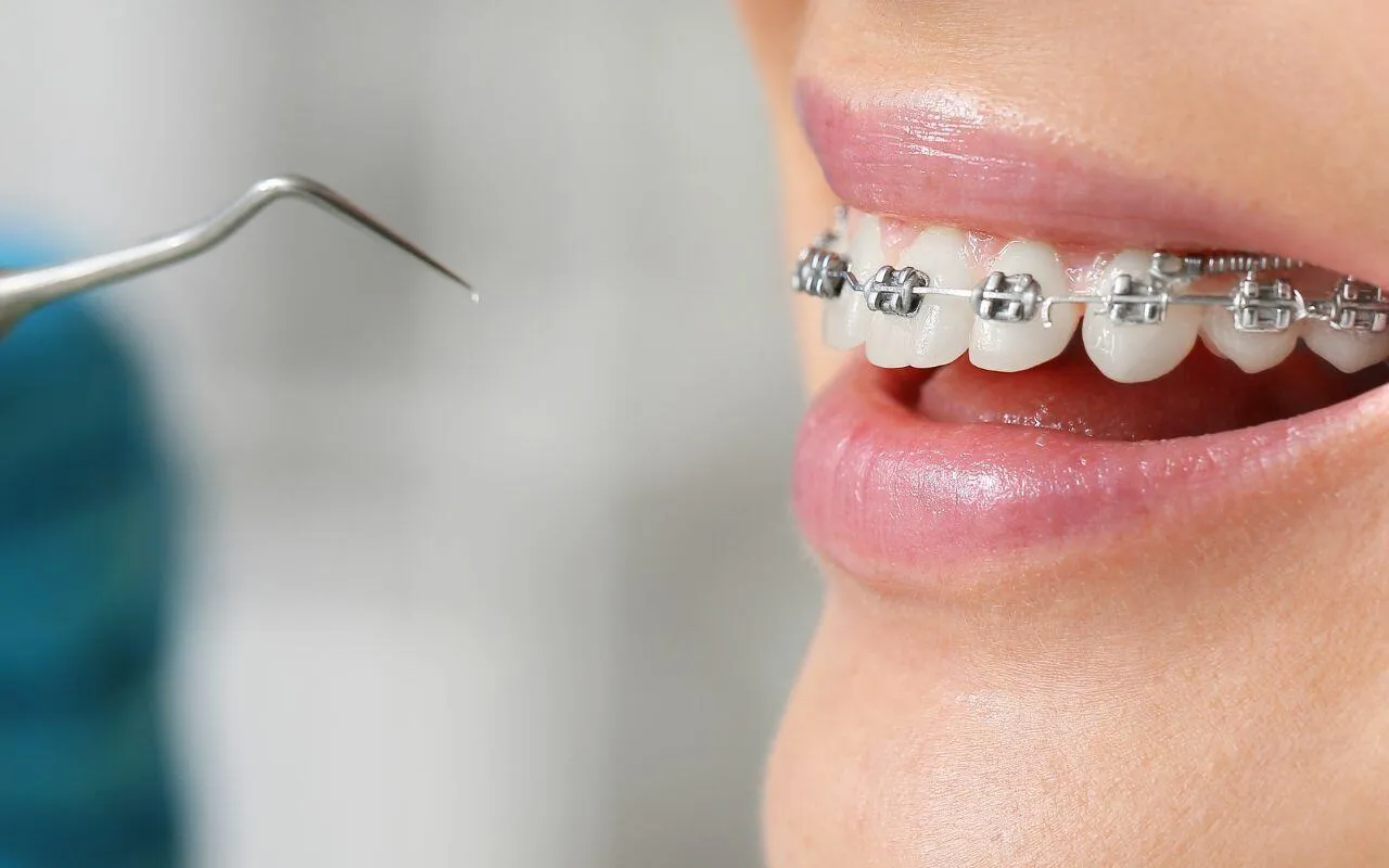 Why Do Braces Brackets Fall Off Sometimes? Bradford Family Dentistry